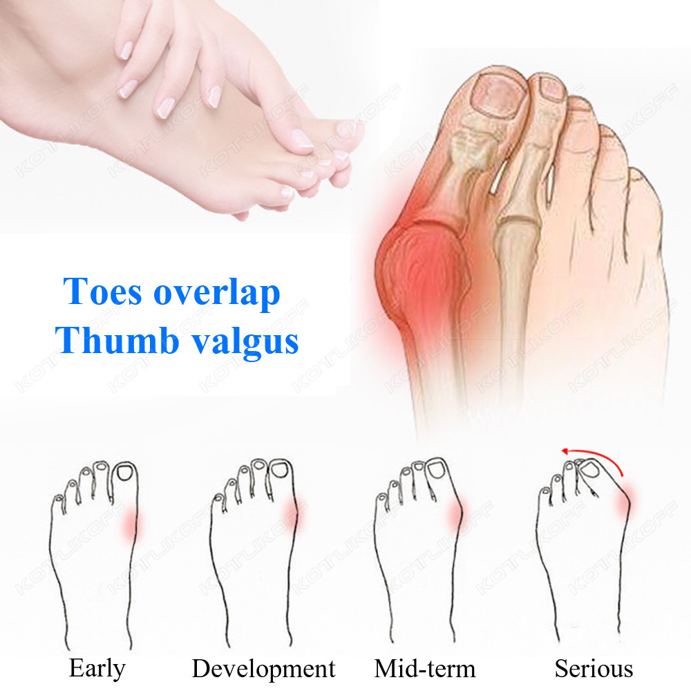 つま先保護 つま先セパレーター シリコーン外反母趾 外反母趾 - Toe Separator Silicon のレビューと価格